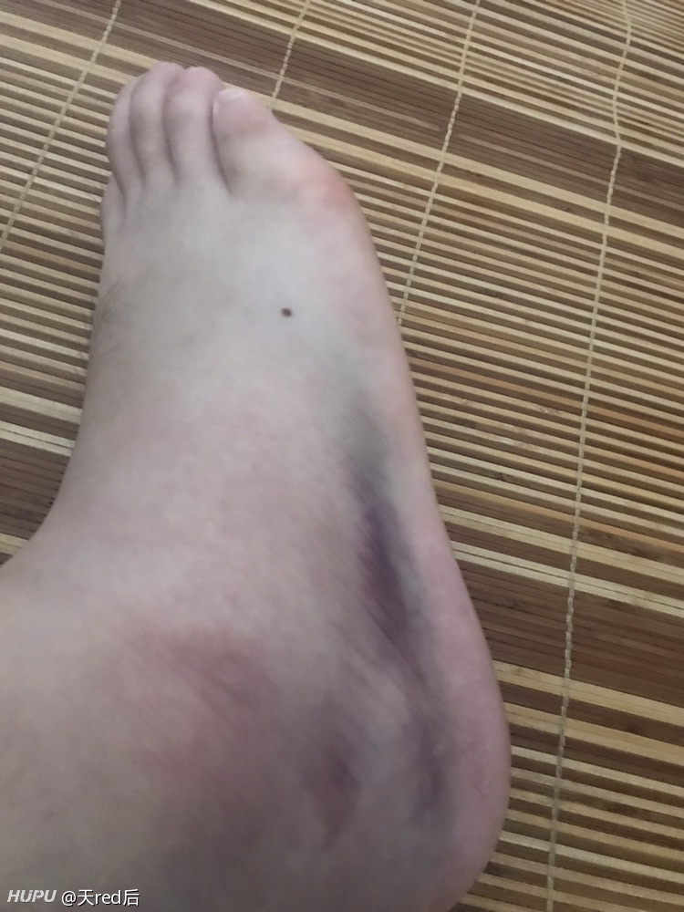 大哥们知道我脚上这个淤血怎么回事吗