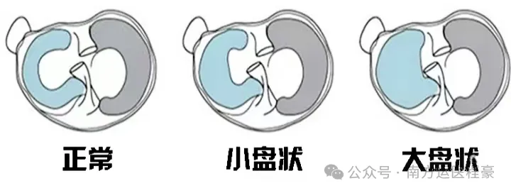 盘状半月板天生的“大号垫片”(图1)