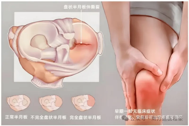 盘状半月板天生的“大号垫片”(图3)