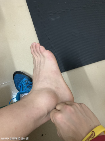 本人朋友昨天打球跳投被垫脚了,伤成这样该怎么办呢?