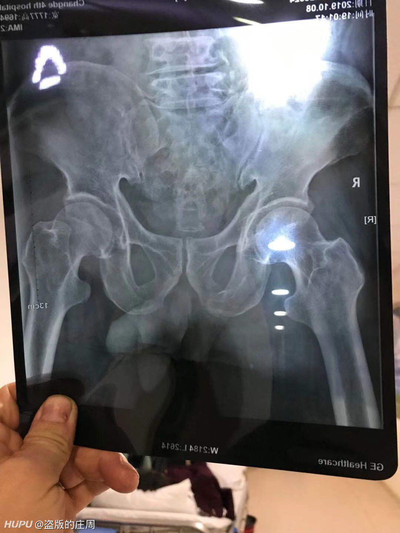 有没有学医的朋友 咨询下医院拍的这个片子 虎扑