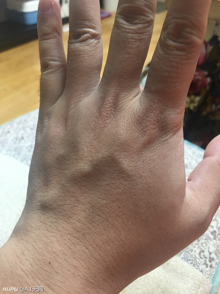 求问,手背上的筋肿胀了用什么护具