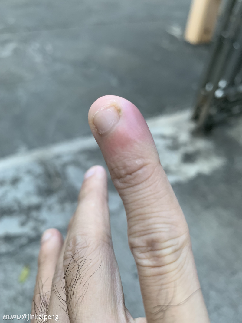 社区 步行街主干道三天前用指甲钳剪指甲,然后拔了一下倒刺,然后稍微