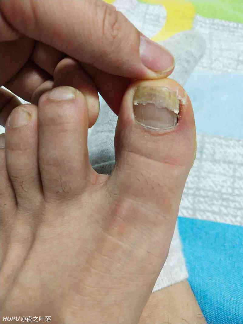 踢球大母脚指甲从中间断了怎么处理 虎扑