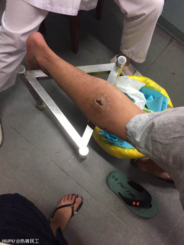 室友腿上突然长了个大包,有懂行的老哥给看看嘛