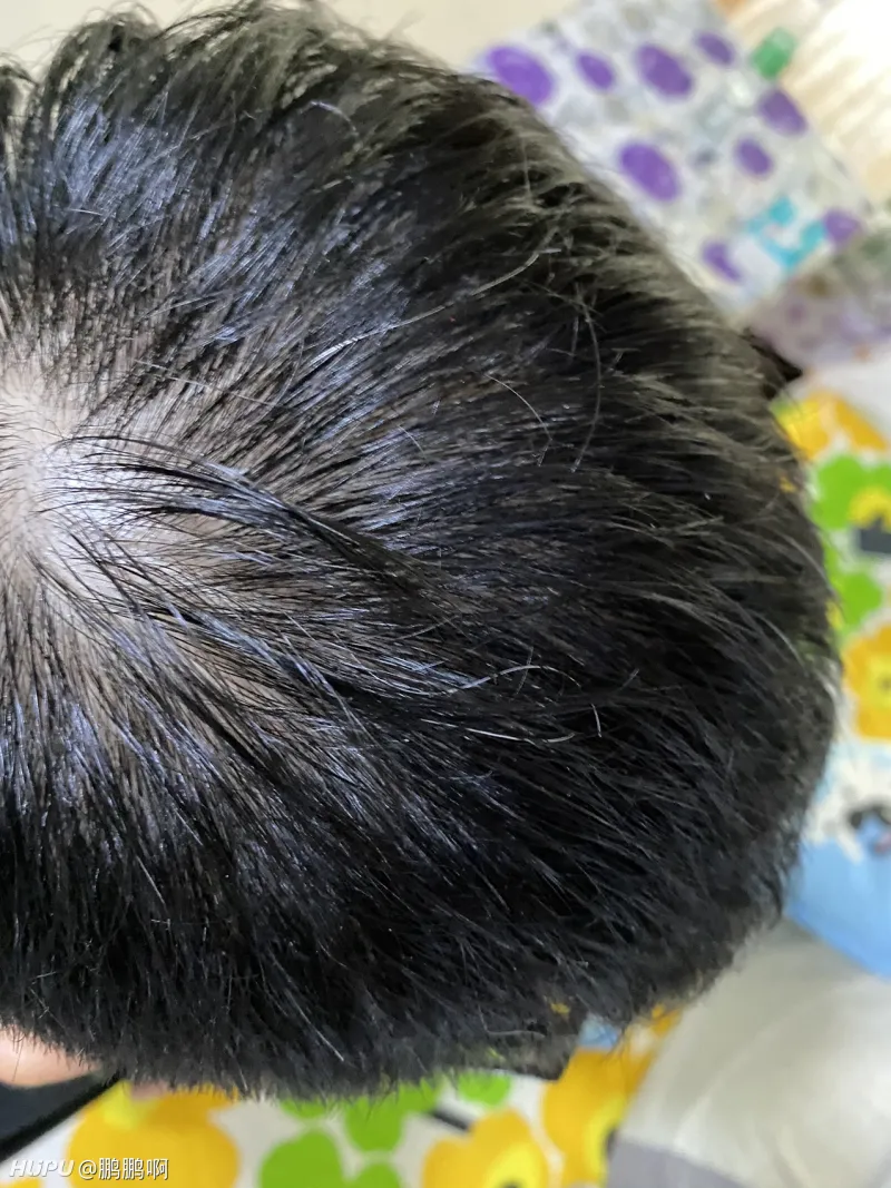 完了啊，这发量，以前没怎么感觉掉头发，怎么突然发现就要秃了呢