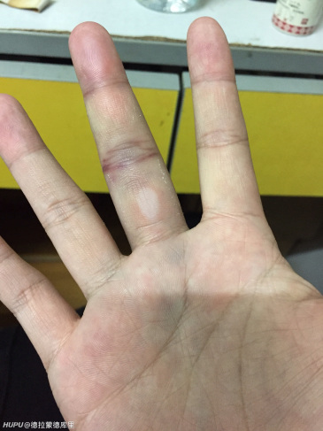 右手中指脱臼过,脱臼后的几天中指跟掌心都是淤血,手指根本无法弯曲