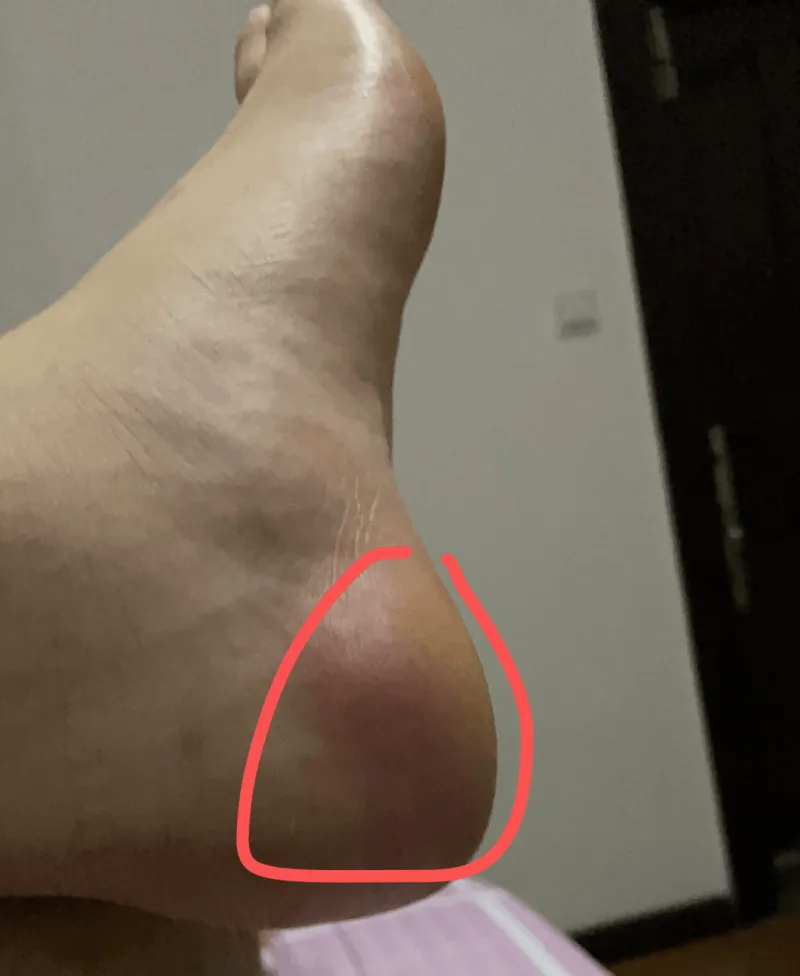 感受两只脚后跟的疼痛，有可能是什么症状呢？还是休息下就好了？😰😰
