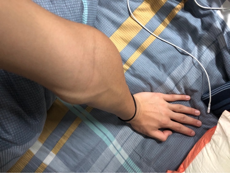 例外我的手也是外翻很严重的