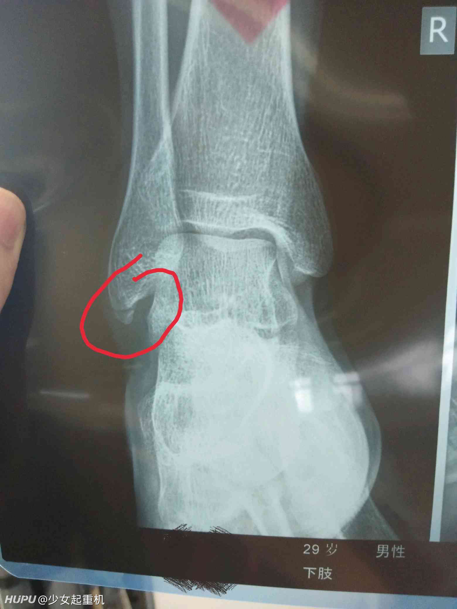 来说说你打球受过最严重的伤吧