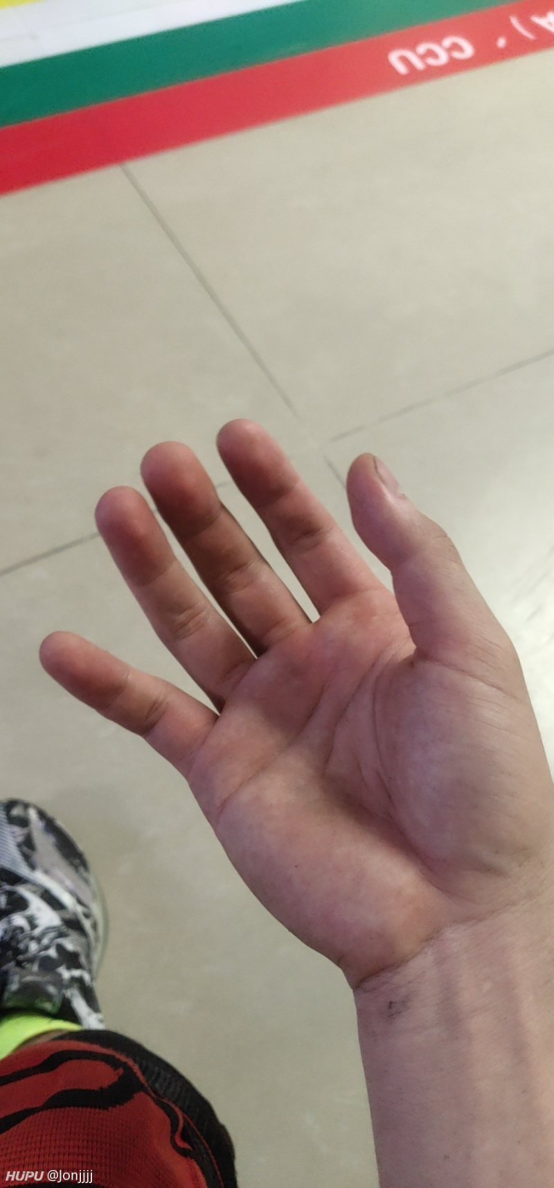今晚打球小拇指错位骨折 有懂的老哥吗 虎扑