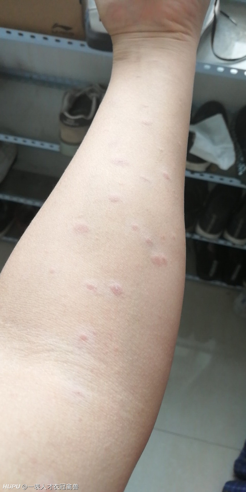 "玫瑰糠疹",如何治啊?