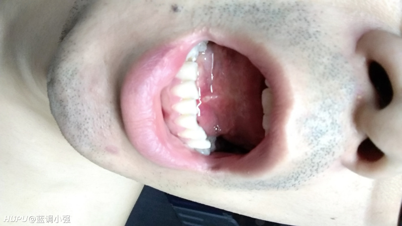 口腔溃疡而论,有比我惨的吗?长舌系带上了