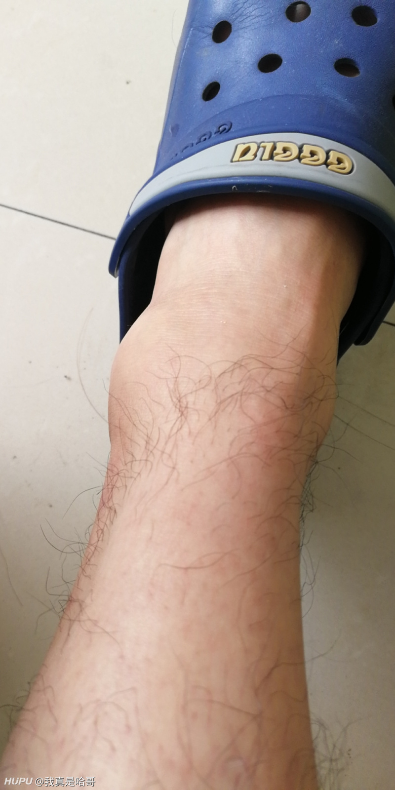 昨天打球崴脚了 这情况多久能打球 虎扑