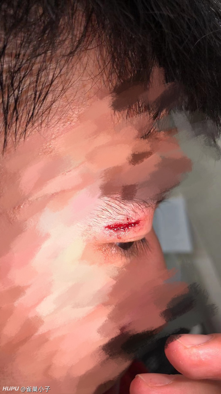 兄弟们打球眉骨开了 缝了针 怎样能走出阴影啊 虎扑