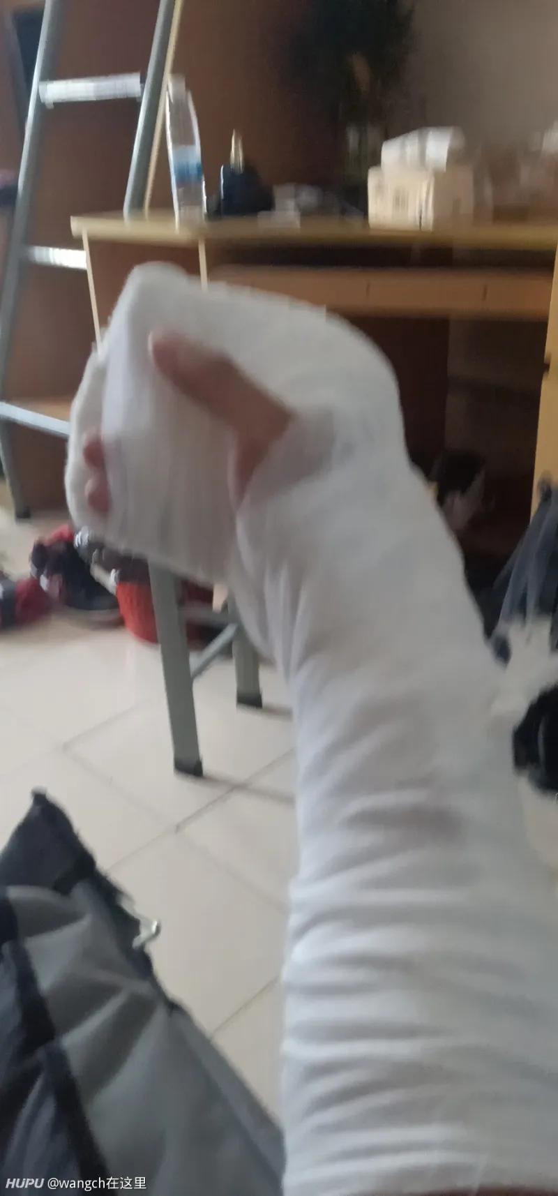 家人们有没有手或脚骨折了打着石膏的照片