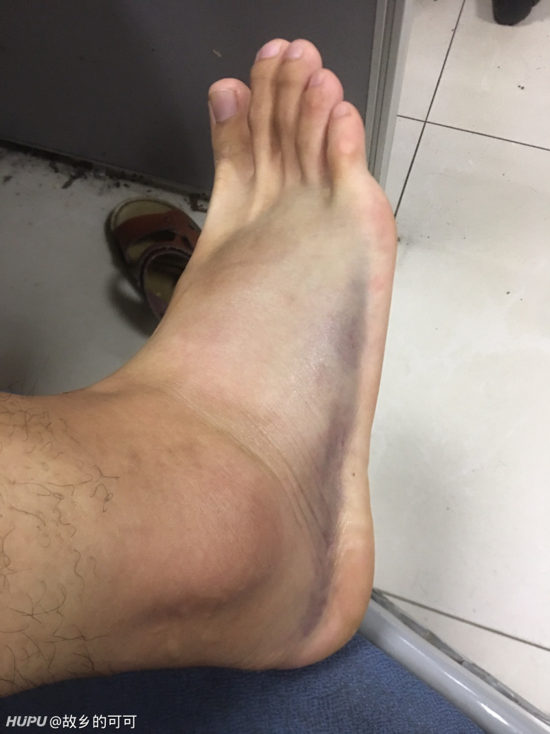 打球第一次扭到脚,要多久才能完全康复